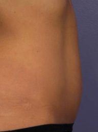Stubborn Fat Removal Without Surgery