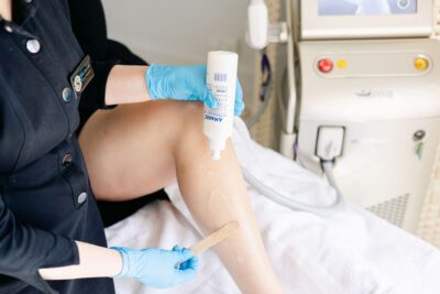 laser hair removal st albans