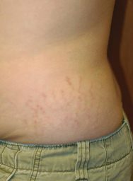 Stretch mark treatment