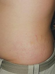 Stretch mark treatment