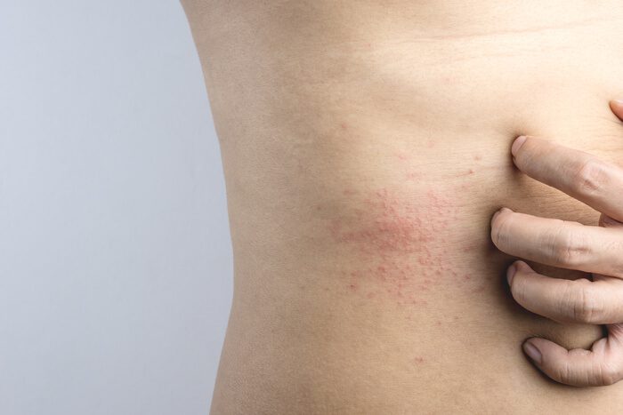 Chlorine Rash & Swimmer's Itch: Pictures, Symptoms, & Treatment