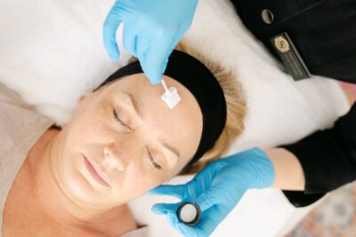 chemical peel treatment st albans