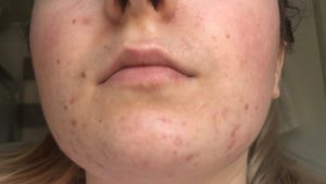 regenlite acne treatment - after