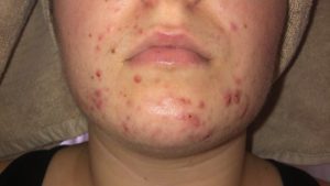 regenlite acne treatment - before 