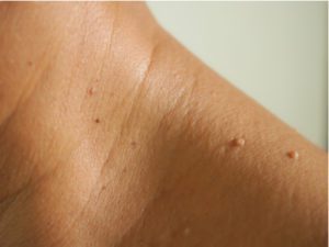 skin tag removal clinic