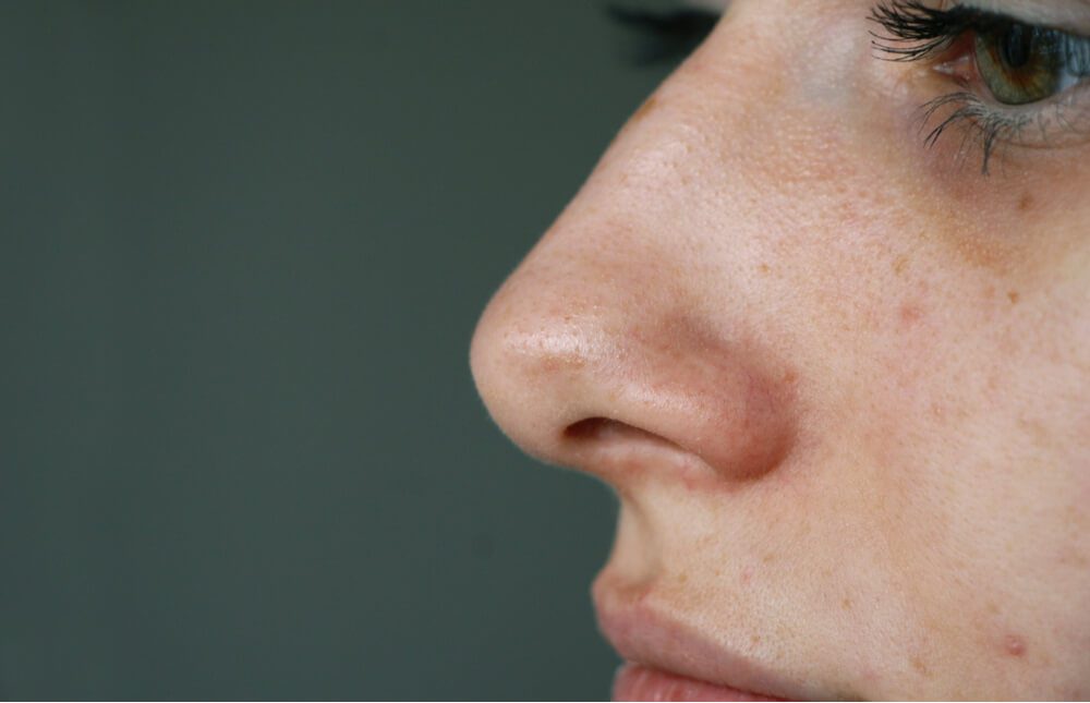 How to Get Rid Blackheads in Oily Skin Skin to Love Clinic