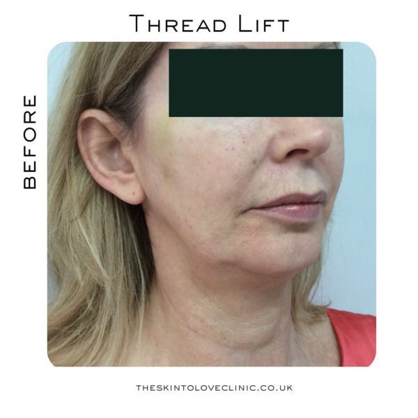 Is Thread Lift Worth it? Thread Lift Before and After S2L