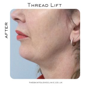 Thread Lift Before and After