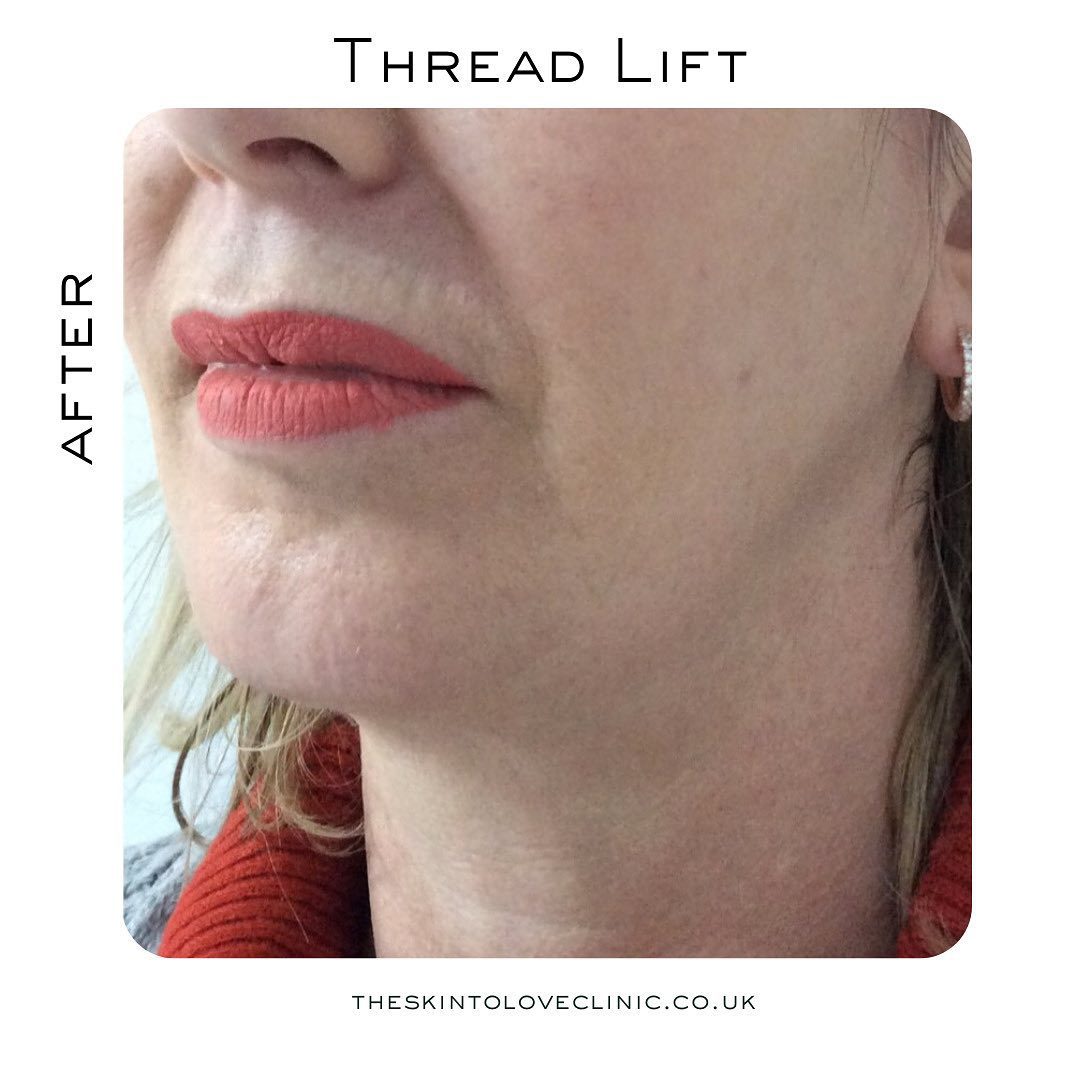 Is Thread Lift Worth it? Thread Lift Before and After S2L