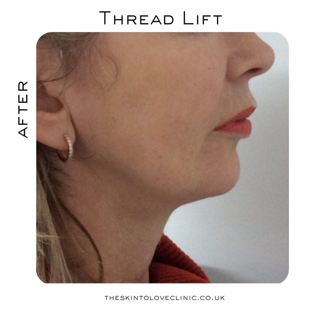 Is Thread Lift Worth it? Thread Lift Before and After S2L