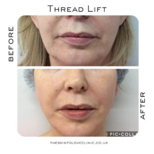 Thread Lift Before and After
