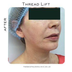 Thread Lift Review