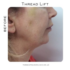 How Is Thread Lift Worth it?