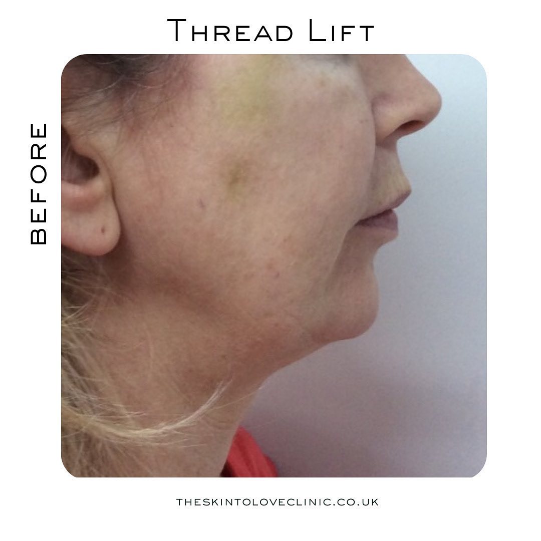 Is Thread Lift Worth it? Thread Lift Before and After S2L