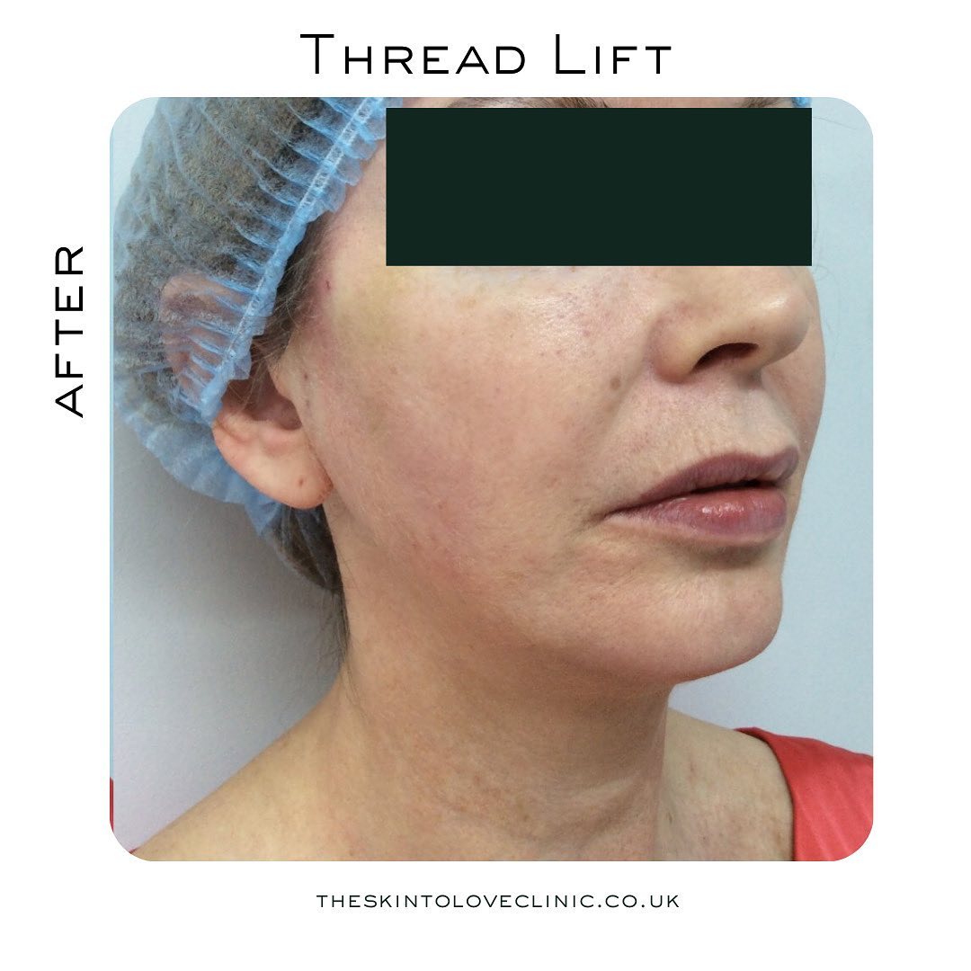 Is Thread Lift Worth it? Thread Lift Before and After S2L