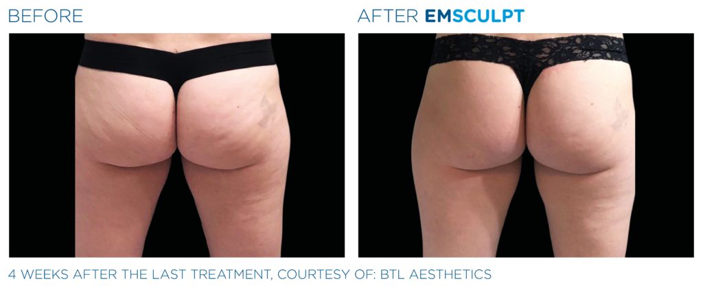 Emsculpt Neo Before and After