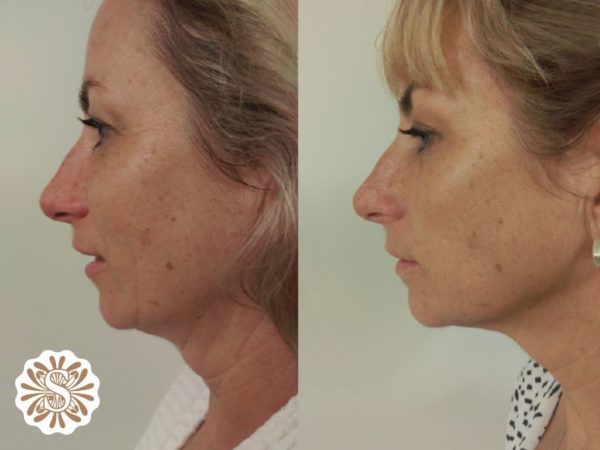hifu-treatment-before-and-after-600x450.jpg?lossy=1&strip=1&webp=1