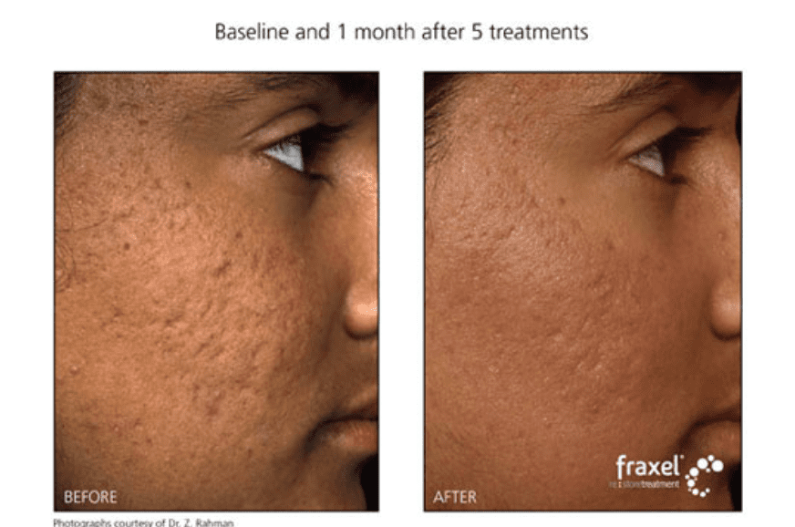 fraxel before and after
