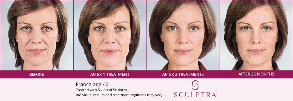 sculptra injections