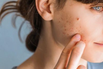 Does Hyaluronic Acid Cause Acne