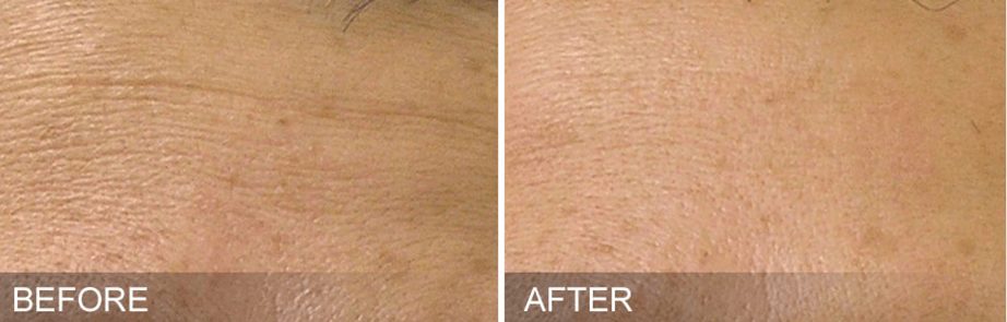 Hydrafacial Before and After