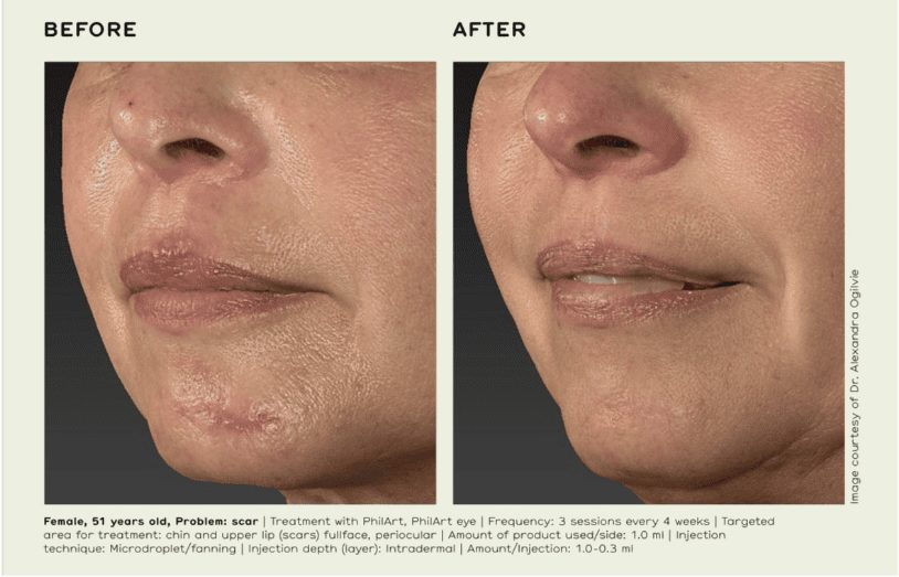 Polynucleotides before and after. Lips and chin