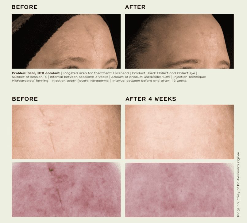 Polynucleotides before and after. Forehead