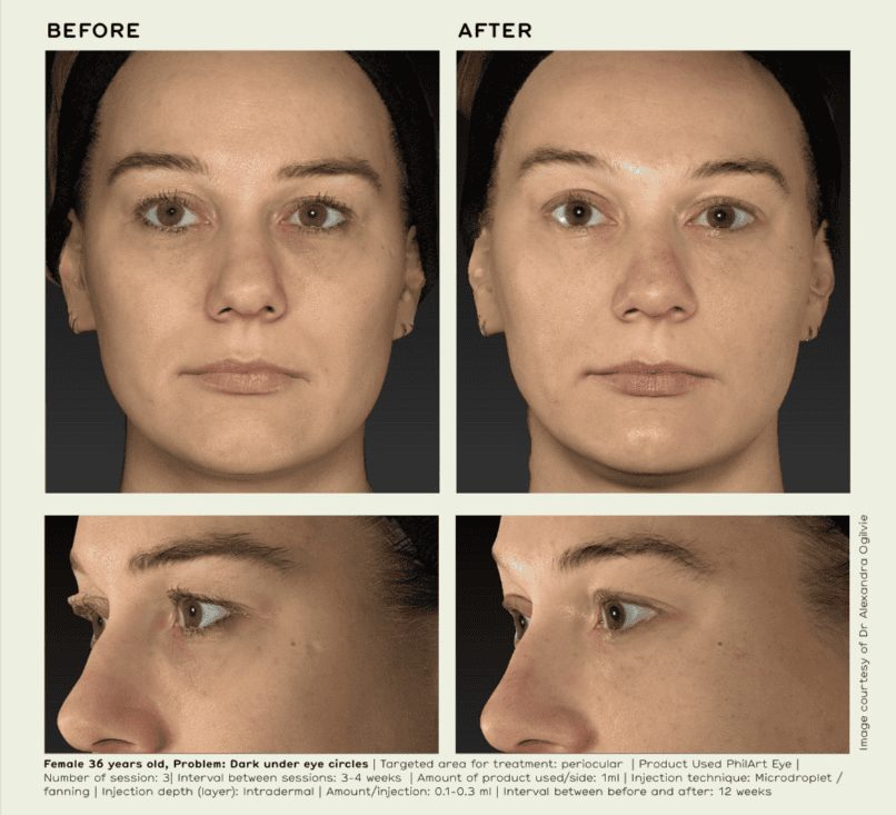 Polynucleotides before and after. Under eye circles