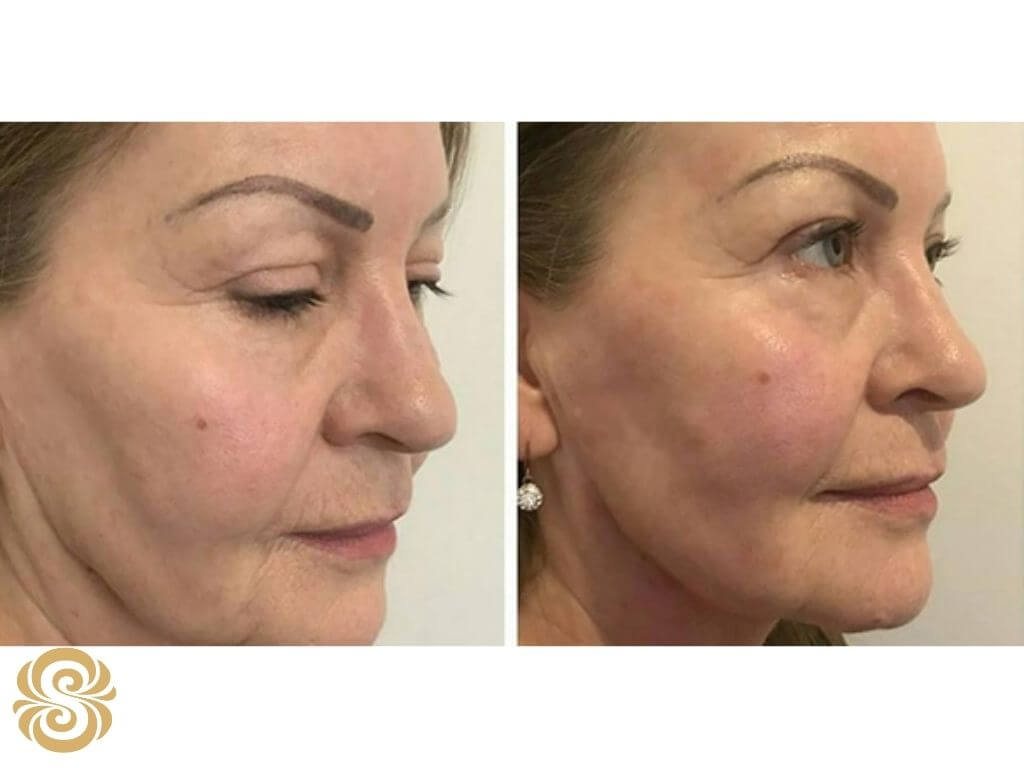 hifu treatment before and after