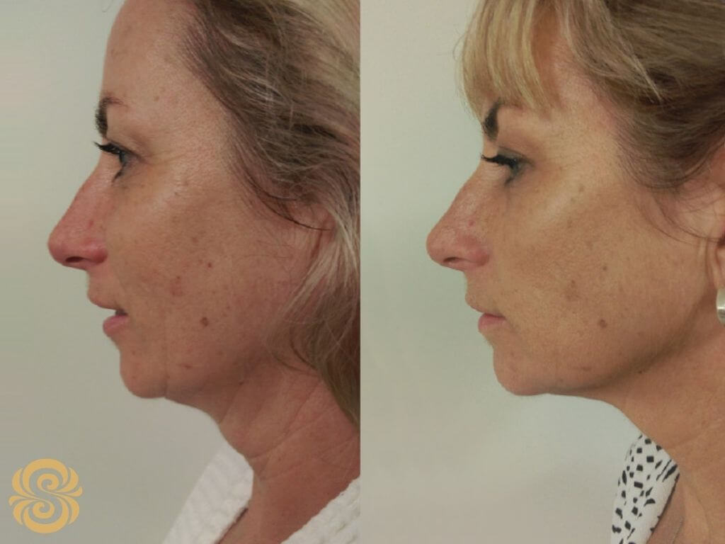 HIFU skin tightening before and after